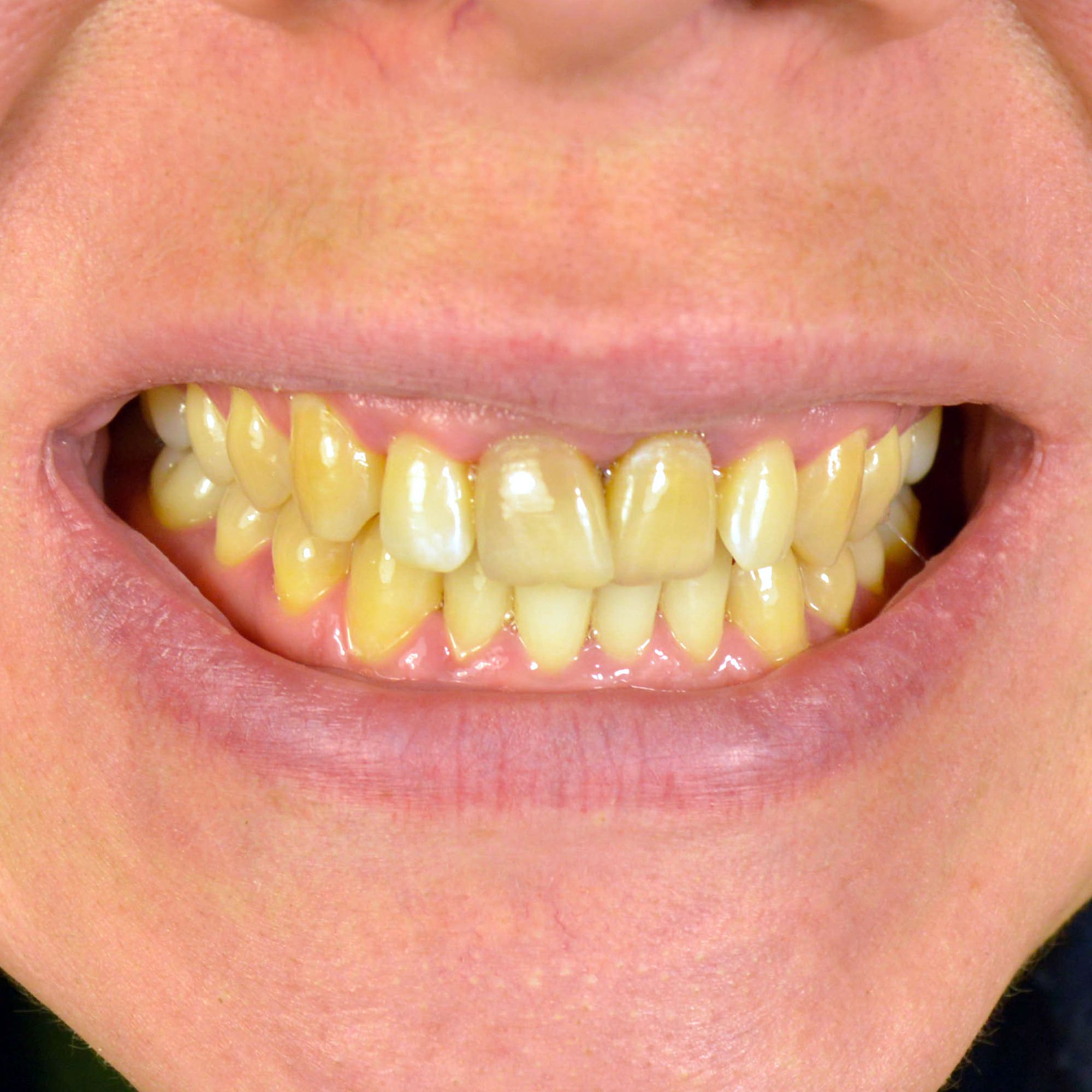 Yellowed Teeth