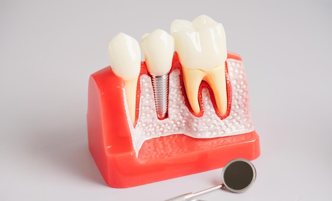 Dental implant