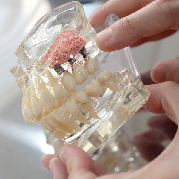 A dental implant with a crown placed in the jaw