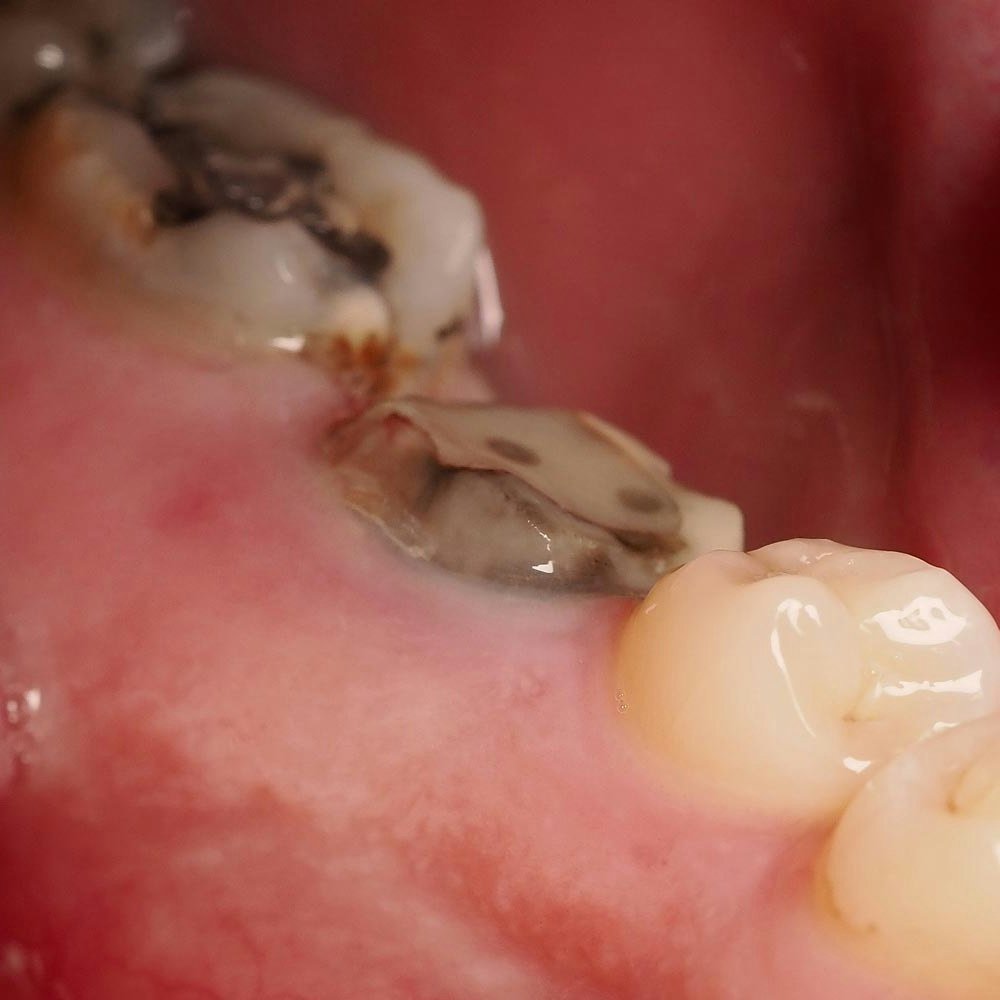 Tooth with root canal