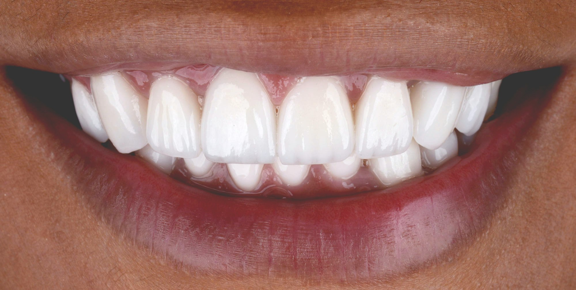 After Porcelain Veneers