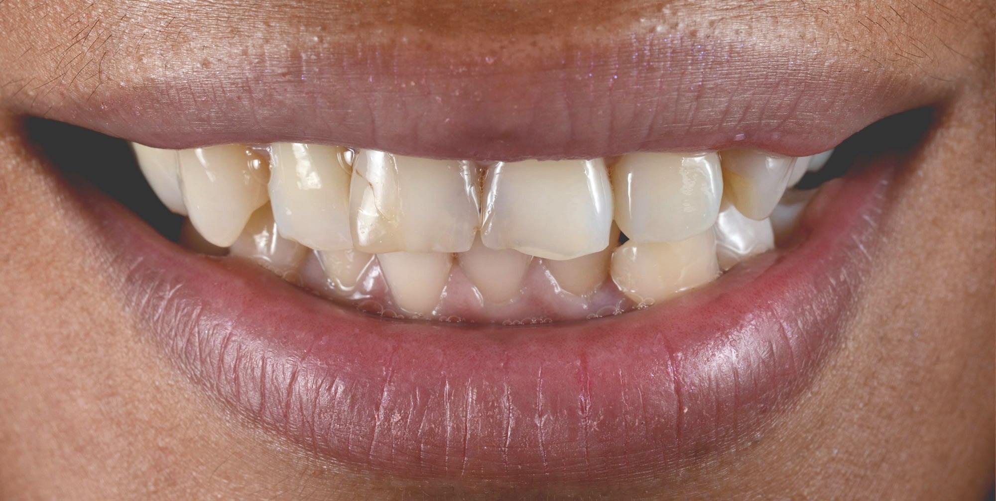 Before Porcelain Veneers