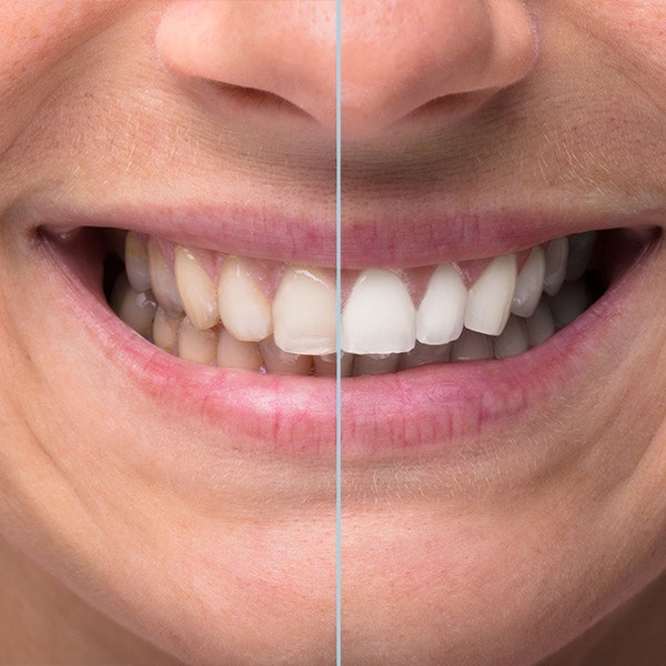 A smile before and after teeth whitening